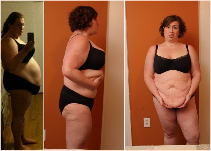 150 Pound Weight Loss Female Skin Rutorresources
