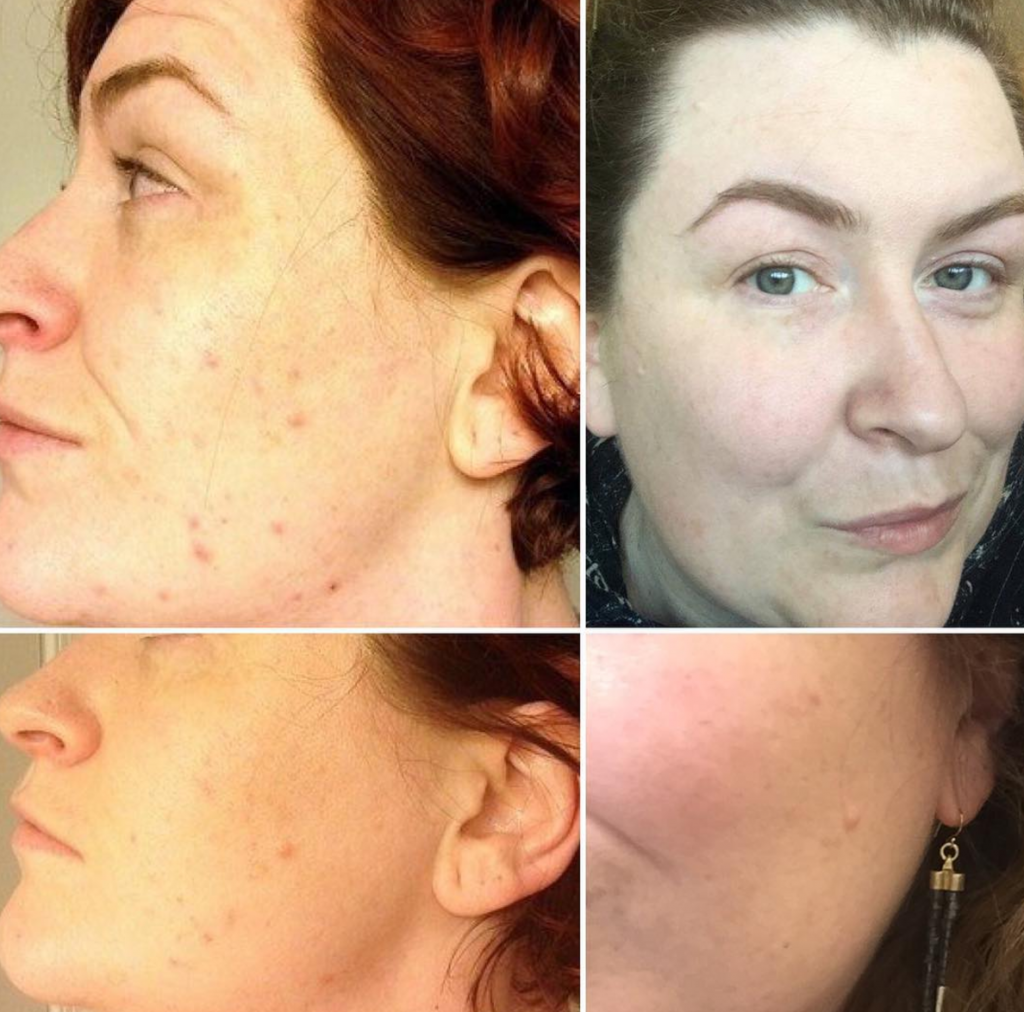 paleo and beautycounter helped adult acne